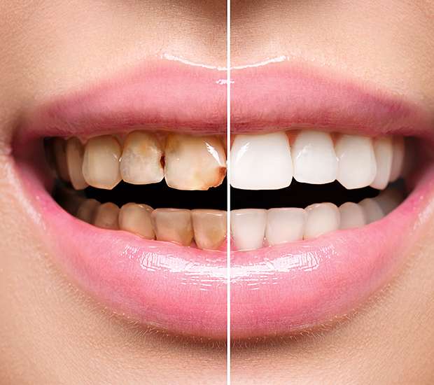 Hutto Dental Implant Restoration